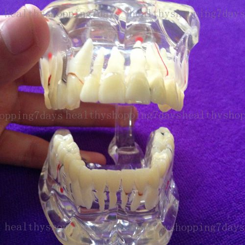 2015 Dental pathology Study Analysis Demonstration Teeth Model with Restoration