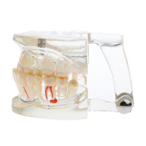 1 x dental implant disease teeth model with restoration bridge tooth for sale