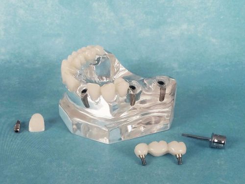 Dental demonstration model, high quality, implant, abutment, education typodont for sale
