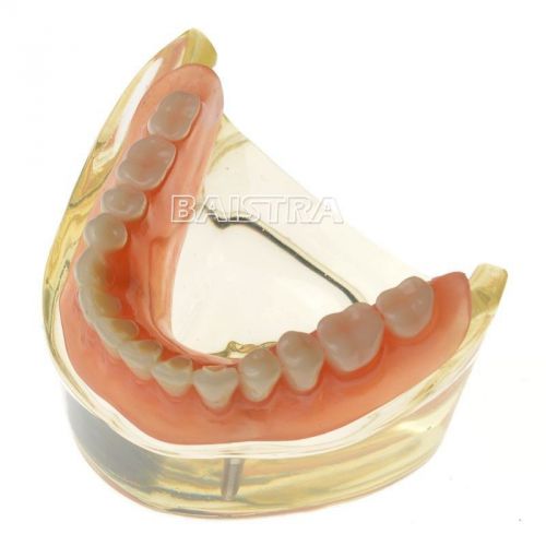 Dental overdenture inferior with 2 implants restoration teeth study teach model for sale