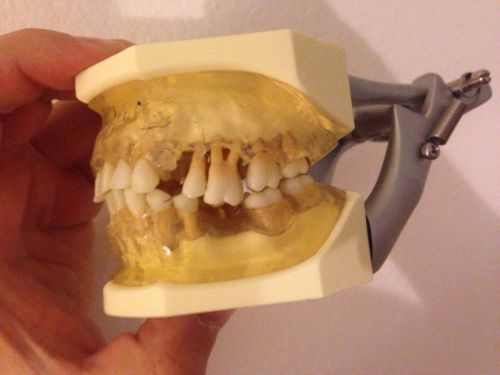 Periodontal Involved Teeth Dental Model For Patient Case Acceptance Root Canal