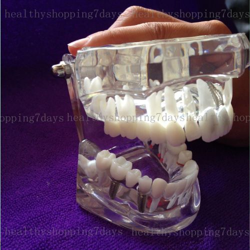 2014 HOT! 1 X Dental Teeth Study Model Classic Implant Model with Restoration