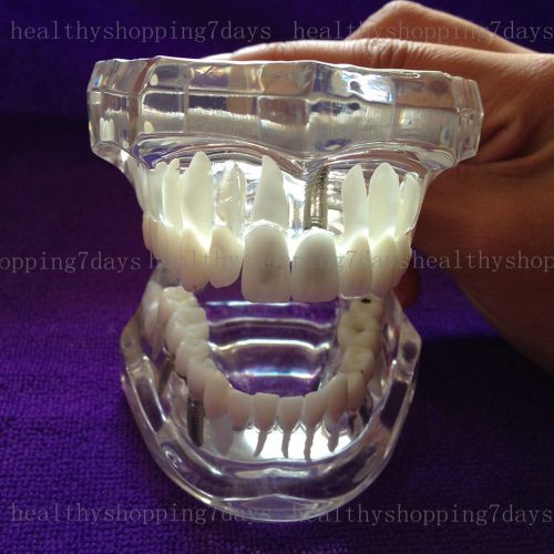 Christams sale! Dental Implant Disease Teeth Model W Restoration &amp; Bridge Tooth