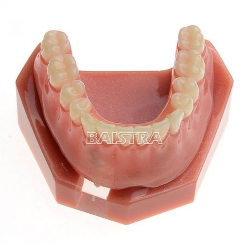 1 Pc Dental Study Teaching Model Teeth Implant Repair Model # 6007 sale