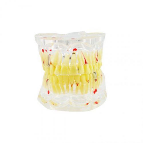 New dental study tooth transparent adult pathological teeth model for sale