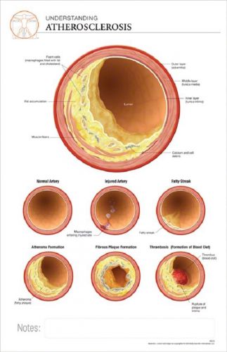 11 x 17 post-it disease chart: atherosclerosis for sale