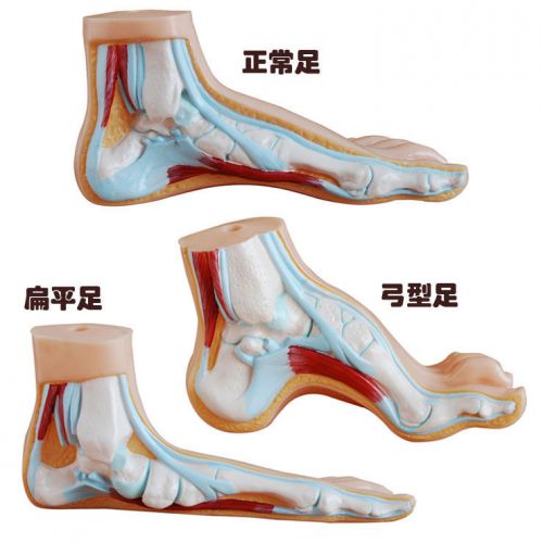NEW Anatomical Model Normal Foot/Flat Foot/Arched Foot Budge Foot 65