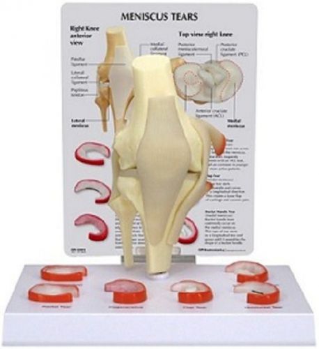 NEW Anatomical Meniscus Tears Complete Model Set