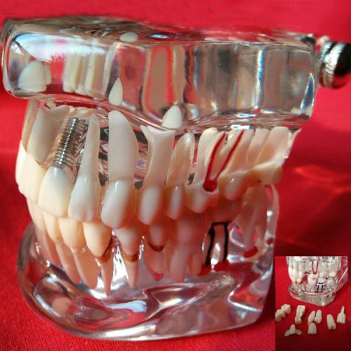Removable Dental Implant Disease Teeth Restoration Bridge Tooth Teaching Model