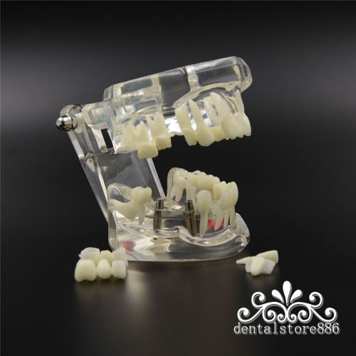 Dentist Dental Implant Disease Teeth Model with Restoration &amp; Bridge Tooth Study