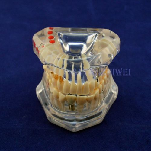 1 Pc Dental Implant Teeth Model with Restoration Bridge Tooth white transparent