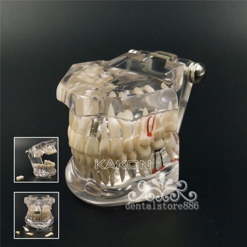 Dental teeth study model classic implant typodont model restoration removable for sale
