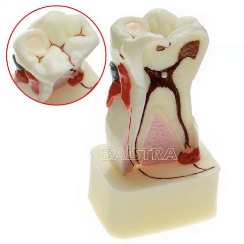 Dental Teeth Model Molar Teaching Teeth Comprehensive Disease Model #4015