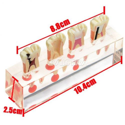Dental Endodontic Treatment good Model for pulposis Study Teach teeth model 4018