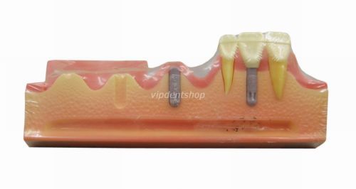New Simulation Dental Teeth Implant Practice Model Tooth Demonstration G007