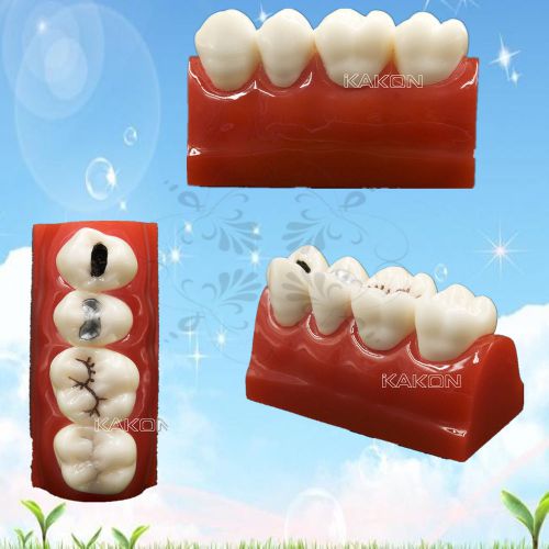 Dental teeth study Cavity Sealing Demonstration tooth Model FREESHIP