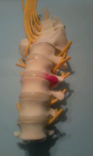 Model of an actual spine with a herniated disk