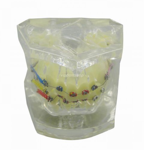 Dental Orthodontic Treatment Study Model With Bracket and Arch Wire G091