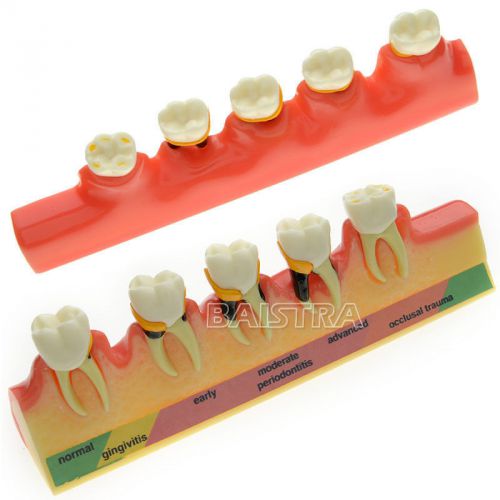 Dental Periodontal Disease Assort Teeth Tooth Typodont Study Teaching Model 4010