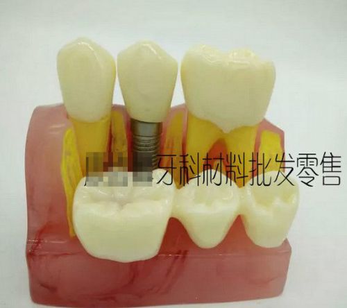 NEW Dental Implant Analysis Crown Bridge Demonstration Teeth Model 52