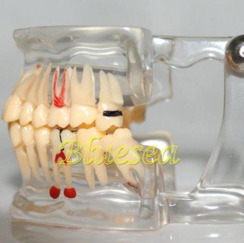 Dental Pathology Study Analysis Demonstration Teeth Model with Implant Removable