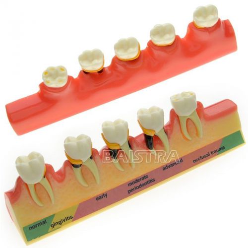 Dental Study Model Periodontal Disease Assort Tooth Typodont Model #4010