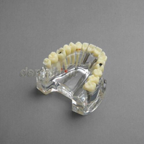 Dental Model #2006 01 - Upper Jaw Implant Model with Bridge and Caries -I
