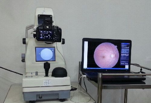 USED FUKUDA FF-3000 DIGITAL  NM RETINAL CAMERA