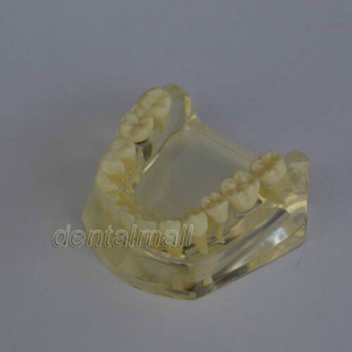 Dentalmall Dental Model #2010 01 - Lower Jaw Implant Model with Bridge