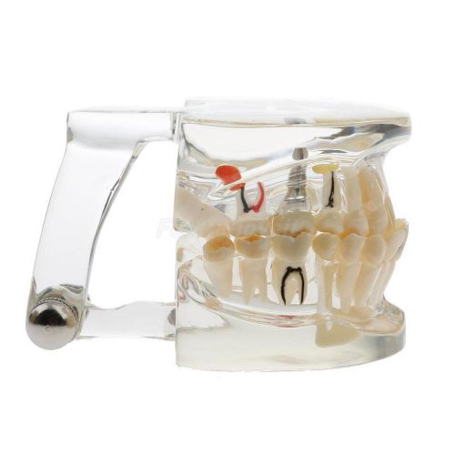 1 x transparent dental implant disease teeth model restoration bridge tooth for sale