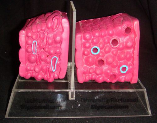 Normal &amp; Ischemic Cardiac Muscle Anatomical Model Heart