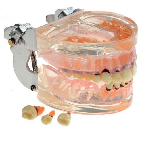 Dental Transparent Adult Pathological Periodontal Disease Teeth Model 4017