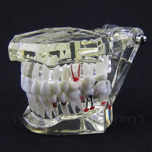 Dental Implant Study Analysis Demonstration Teeth Model #2001 with Restoration