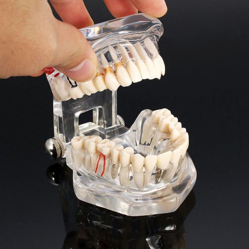 Disease Removable Study Teach Implant Teeth Model With Restoration Bridge Tooth