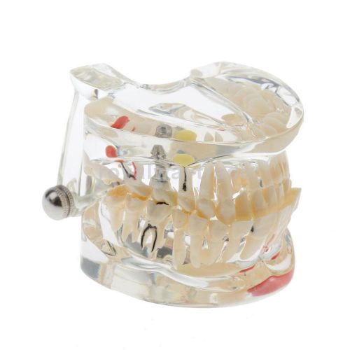 Dental lab tooth pathological extrusion teeth model implant disease for sale