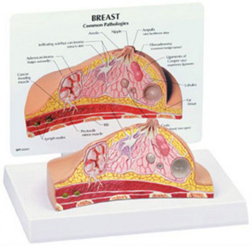 NEW Anatomical Breast Cancer Cross Section Model