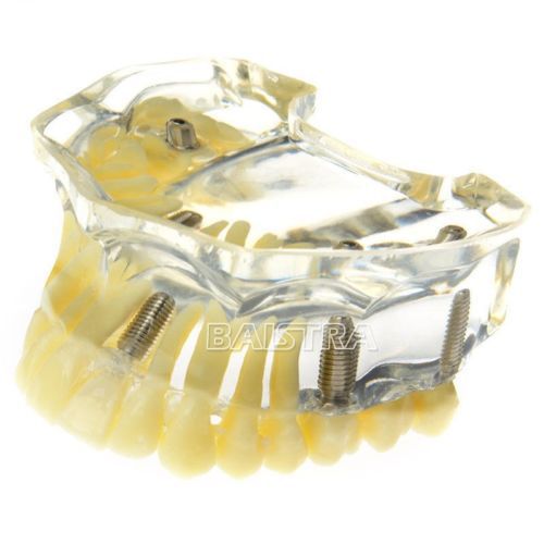1 Pc Dental Implant upper teeth model Transparent gum Implant nails study 6008