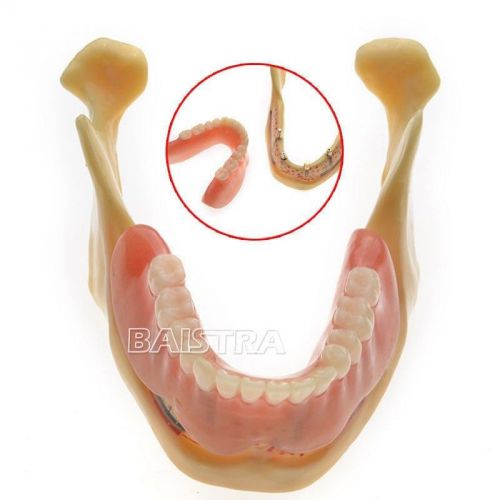 Dental teeth implant model of the lower jaw for study teach zyr-2014 for sale