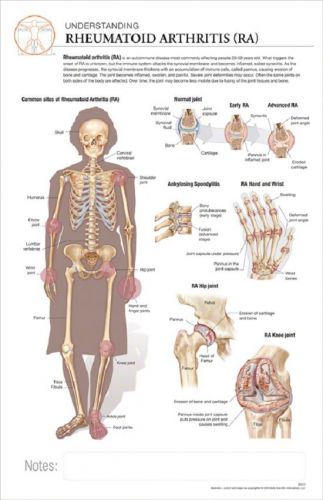 11 x 17 post-it disease chart:  rheumatoid arthritis for sale