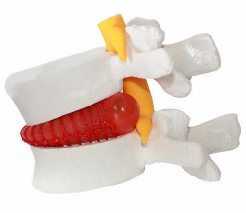1*medical demonstration spine lumbar disc herniation teaching model 1:1.5 for sale