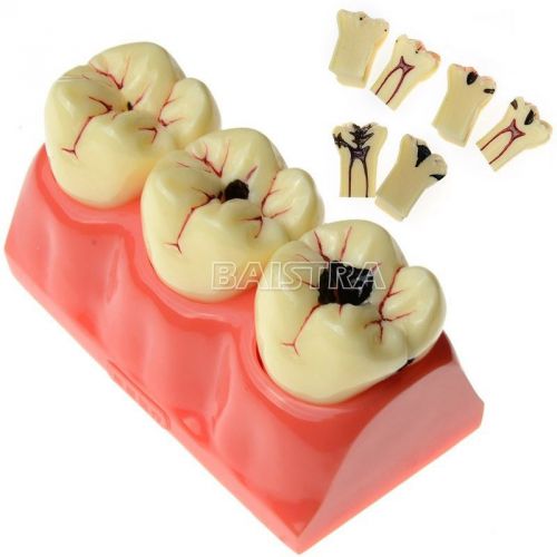 Dental patient education teeth model caries treatment model #4013 red color for sale