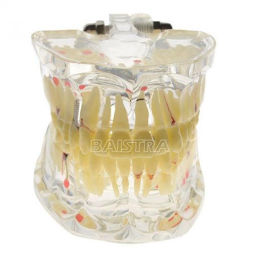 Dental Teeth Model Adult Pathologies Transparent Gum Display Diseases #4001-I