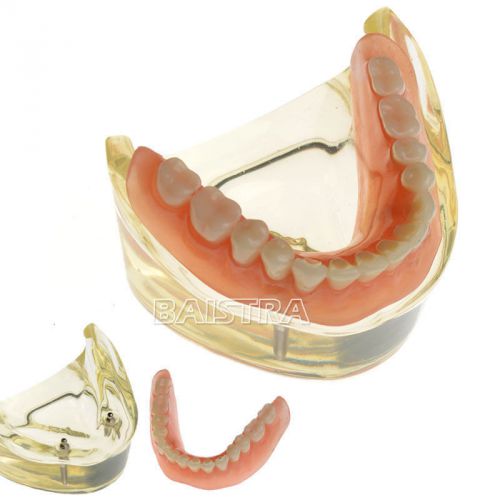 Dental Restoration Teeth Study Teach Model Overdenture Inferior with 2 Implants