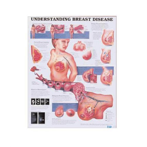 Understanding Breast Disease Cancer * Anatomy Poster * Anatomical Chart Company