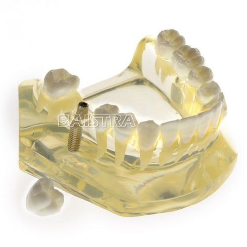 Dental Teeth Study Implant Model ZYR-2010-I