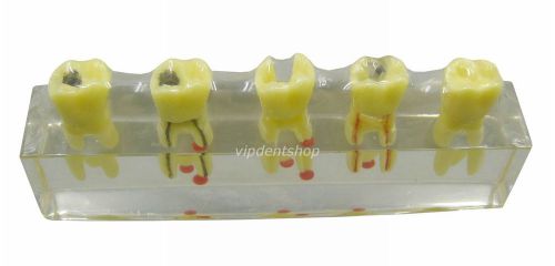 1*XINGXING 4012 Oral Root Treatment Tooth Model For Teaching 4012 vip