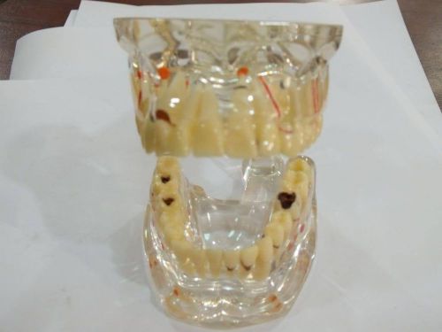 Dental Tooth Acrylic Root Canal Model All Disease