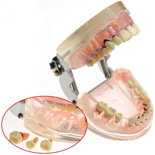 Dental Study Teeth Model Transparent Adult Pathological Periodontal disease 4017