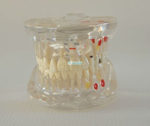 2x hs dental tooth study model restoration pathology education teaching display for sale