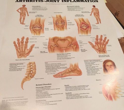 Arthritis-Joint Inflammation Rheumatoid * Anatomy Poster * Anatomical Chart Comp